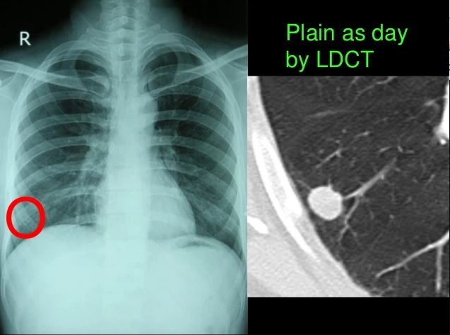 CHỤP CẮT LỚP VI TÍNH PHỔI LIỀU THẤP NHẰM SÀNG LỌC SỚM UNG THƯ PHỔI TẠI BỆNH VIỆN ĐA KHOA TỈNH HẢI DƯƠNG